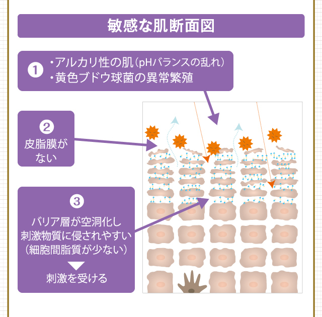 1.アルカリ性の肌（pHバランスの乱れ）・黄色ブドウ球菌の異常繁殖2.皮脂膜がない3.バリア層が空洞化し刺激物質に侵されやすい（細胞間脂質が少ない）→刺激を受ける